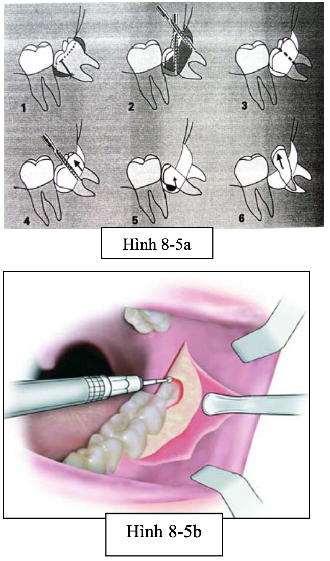 Tiểu phẫu R8 nghiêng gần